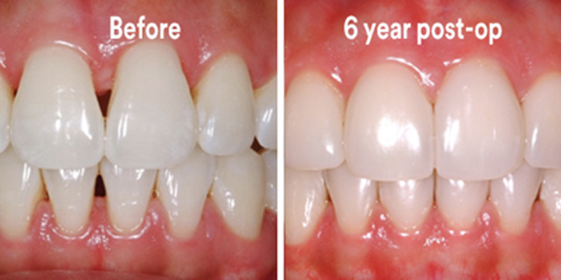 BioClear Diastema Closure and Black Triangle Closure  - Galleria Dental, Mundelein Dentist