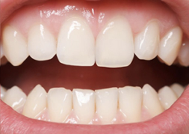 Cosmetic Bonding  - Galleria Dental, Mundelein Dentist