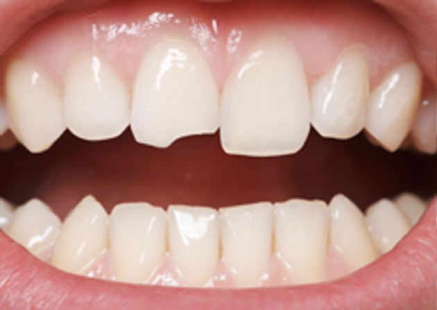 Cosmetic Bonding  - Galleria Dental, Mundelein Dentist