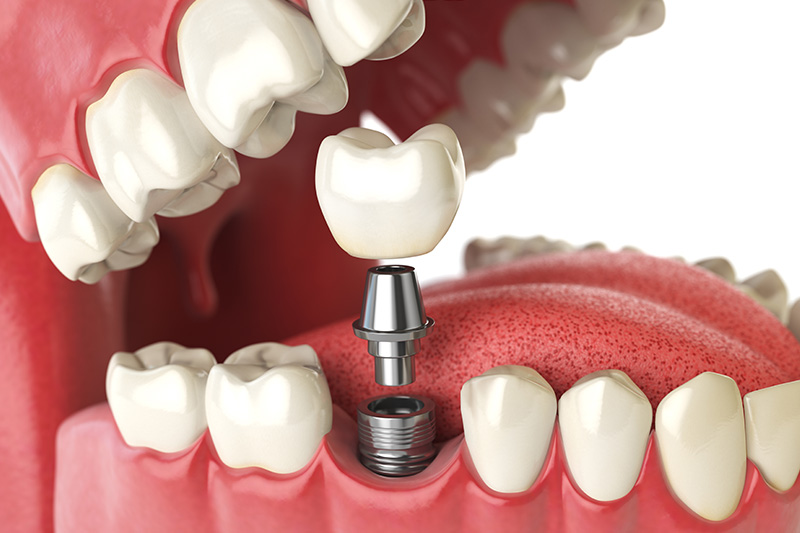 Dental Implants - Galleria Dental, Mundelein Dentist