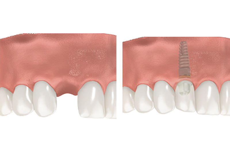 Dental Implants - Galleria Dental, Mundelein Dentist