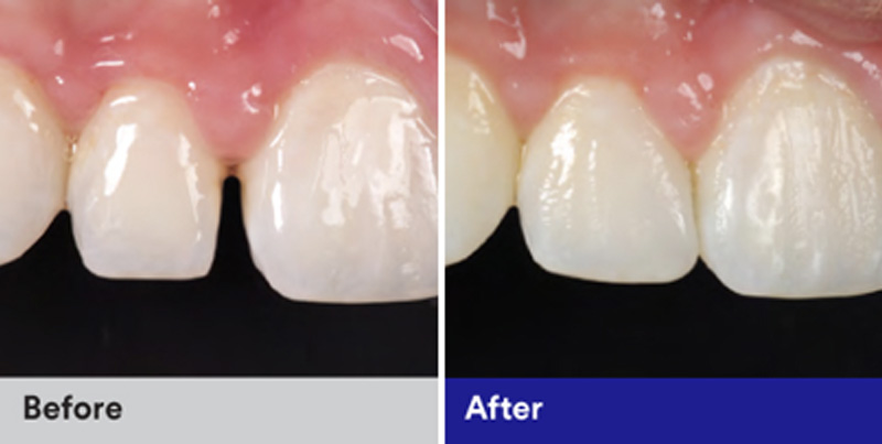 BioClear Diastema Closure and Black Triangle Closure  - Galleria Dental, Mundelein Dentist