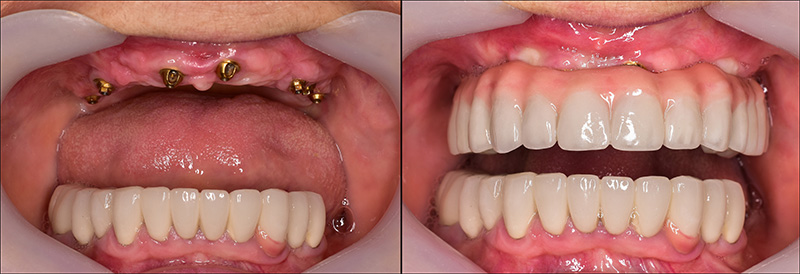 Implant Overdentures and Fixed All-On-X Treatment  - Galleria Dental, Mundelein Dentist