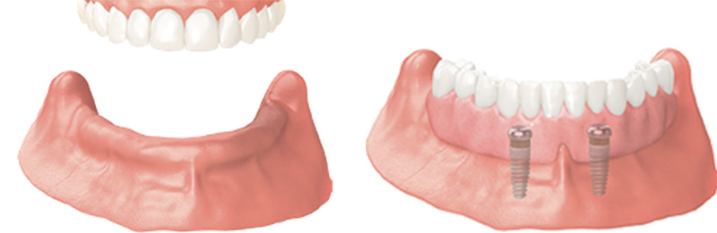 Implant Overdentures and Fixed All-On-X Treatment  - Galleria Dental, Mundelein Dentist