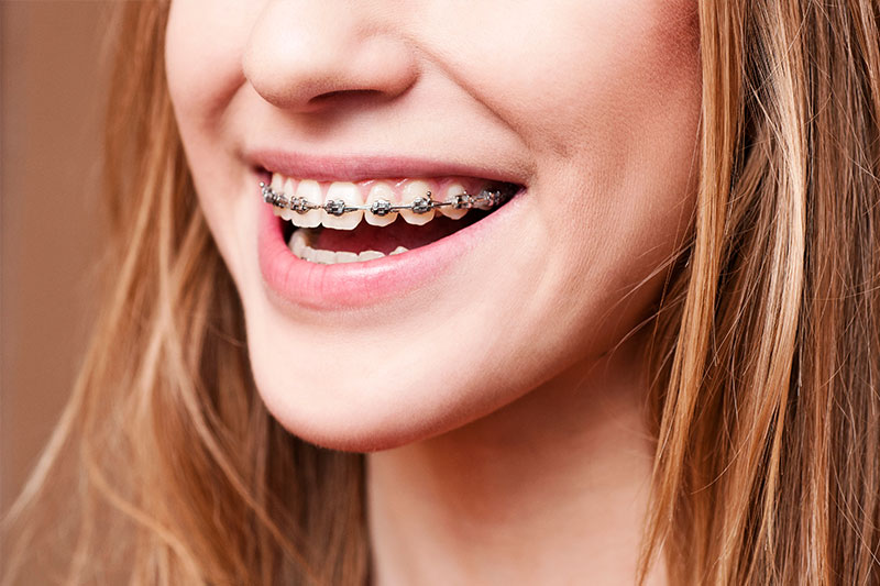 Orthodontics - Galleria Dental, Mundelein Dentist