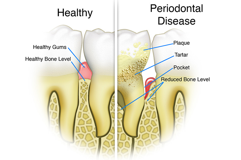 Scaling & Root Planings (Deep Cleanings)  - Galleria Dental, Mundelein Dentist