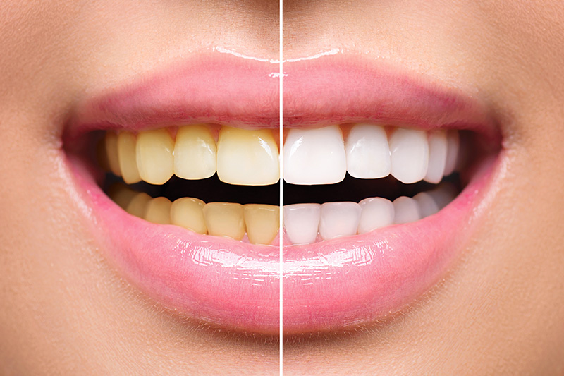 Teeth Whitening - Galleria Dental, Mundelein Dentist