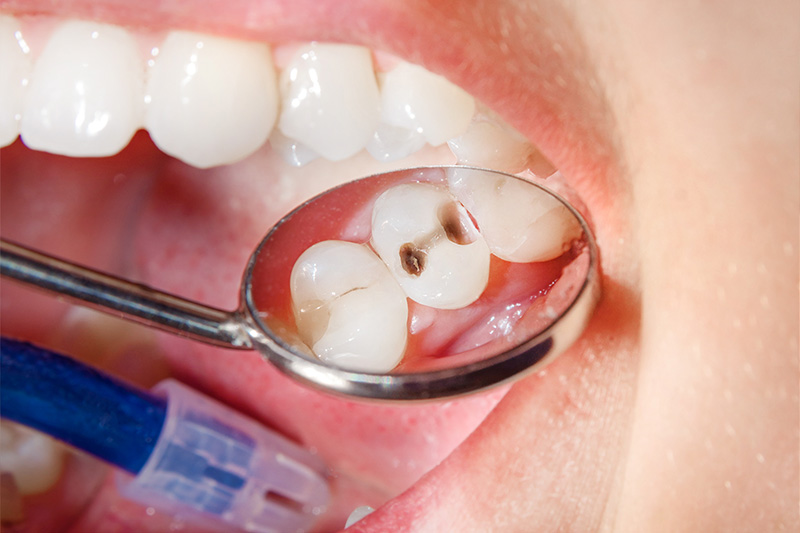 Tooth Colored Composite Fillings  - Galleria Dental, Mundelein Dentist