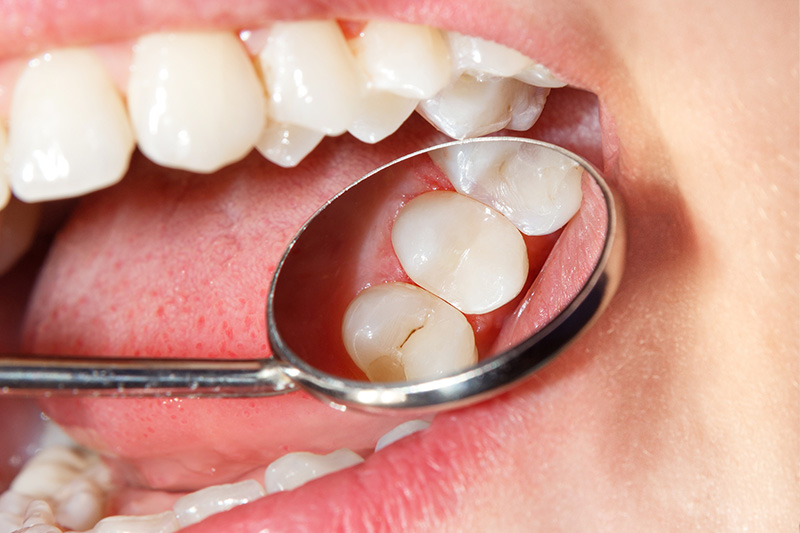 Tooth Colored Composite Fillings  - Galleria Dental, Mundelein Dentist