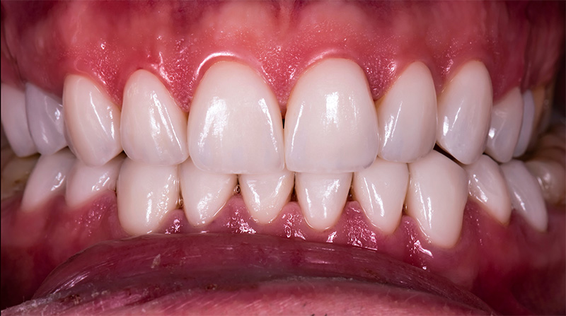 Veneers  - Galleria Dental, Mundelein Dentist