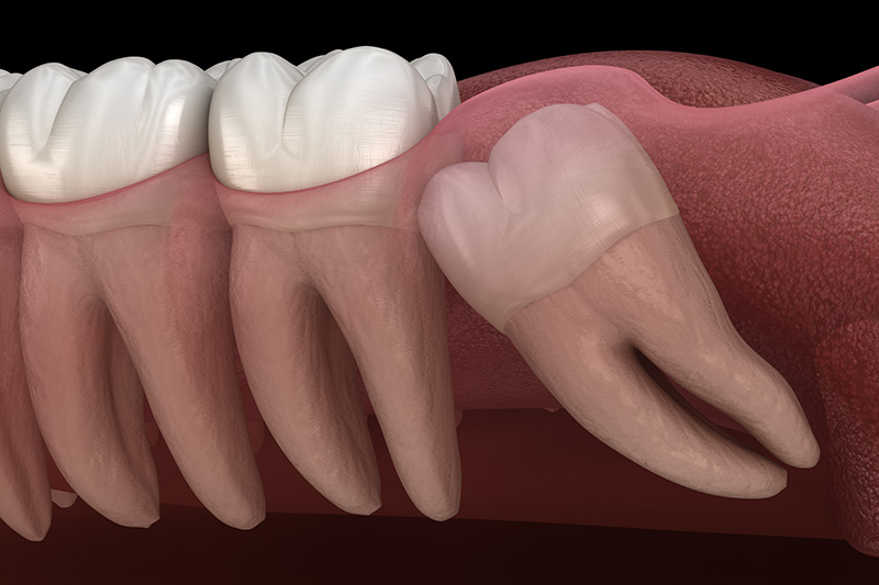 Extracciones de Muelas del Juicio (con Sedante)  - Galleria Dental, Mundelein Dentist